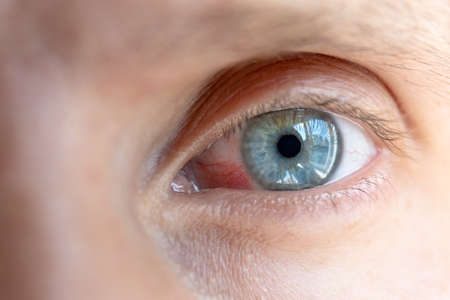 male inflamed eye with red capillariesの写真素材