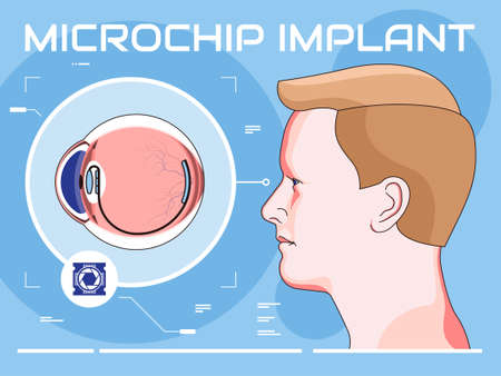 Vector illustration of modern micro eye implantationのイラスト素材