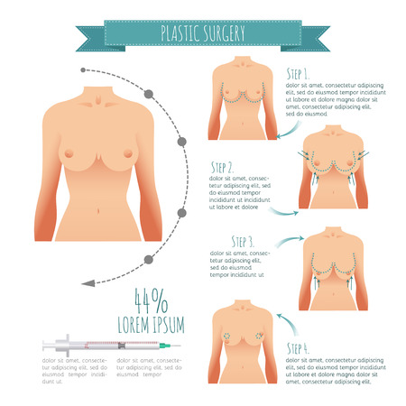 Plastic surgery illustrations. Breast augmentation, breast liftのイラスト素材