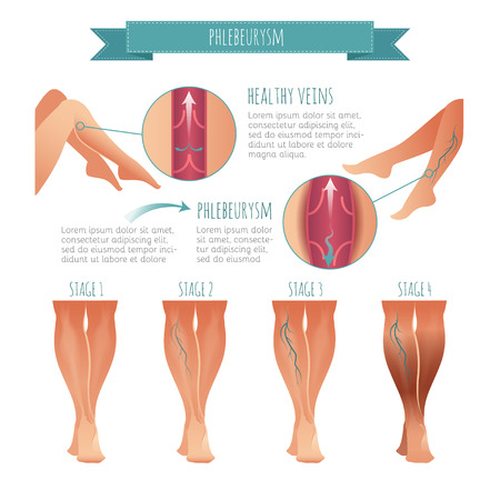 Vector Phlebology infographic. Stage of vein diseasesのイラスト素材