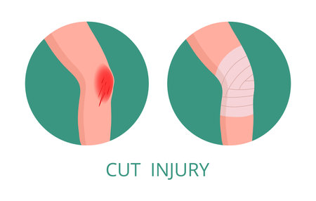 Knee injury medical treatment. Human body part first aid infographic, injured human leg first aid methods flat vector illustration. Cartoon medical bandagingのイラスト素材