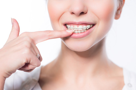 Beautiful young woman with teeth bracesの写真素材