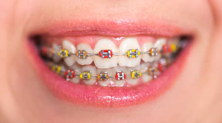 Multi-colored bracket system. Dental concept. close-up shot