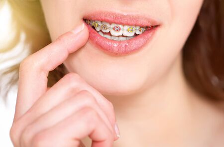 Beautiful girl with perfect skin and multi-colored braces posing on white backgroundの写真素材