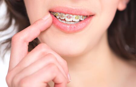 Beautiful girl with perfect skin and multi-colored braces posing on white backgroundの写真素材