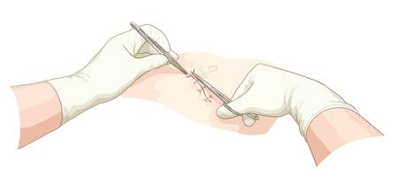 The surgeon takes in a wound. Vector illustration.のイラスト素材