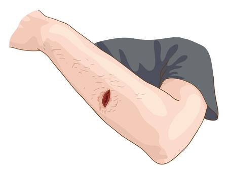 The Wound. Vector illustration.のイラスト素材