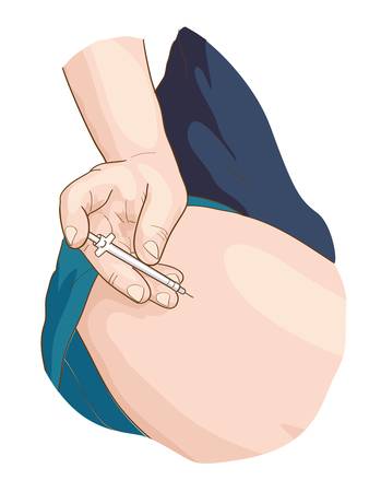 Insulin injection in a leg.  illustration.のイラスト素材