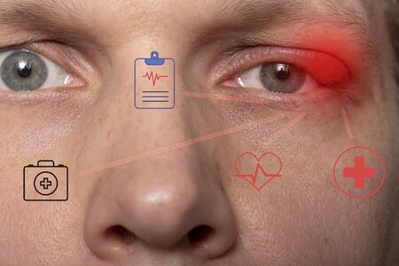 Close the upper left eyelid abscess. Eye with barley. Barley diseases, the concept of disease development.の写真素材