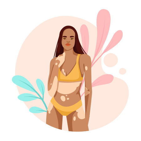 Young woman with pigmentation on skin. Girls body positive concept. Woman in swimsuit not shy about her body. Pigment spots dermatology desease. Flat vector illustration isolated on white backgroundのイラスト素材