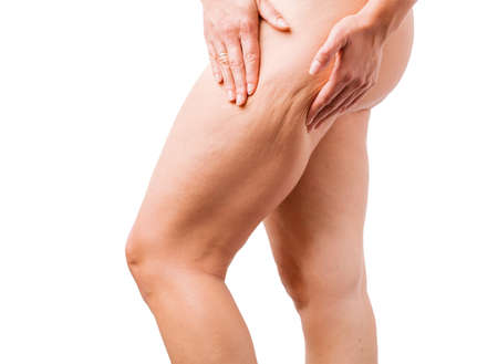 Cellulite problemの写真素材