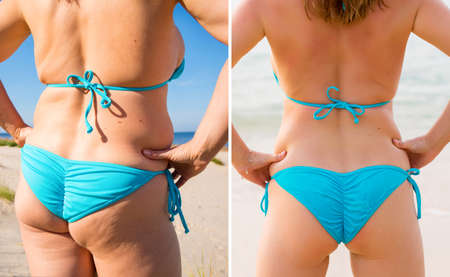 Woman's buttocks before and after weight lossの写真素材
