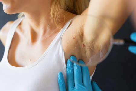 Doctor inspecting birthmarks on patientの写真素材