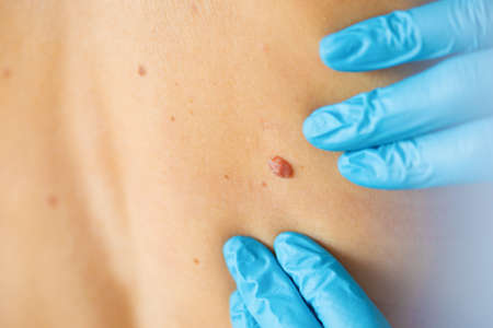 Dermatologist examine birthmark on patient's skinの写真素材