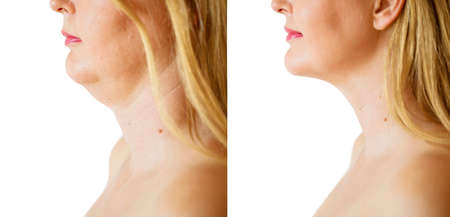 Woman before and after chin fat correction procedureの写真素材