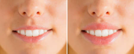 Woman's lips before and after filler injectionsの写真素材