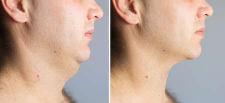 Man before and after double chin fat correction procedureの写真素材