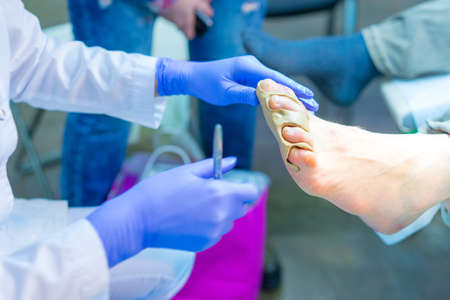 Medical procedure with legs. A mold of the feet. Treatment of toes.の写真素材
