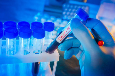 Covid 19. Coronavirus. Doctor detected a virus infection. Test tube infected with coronavirus blood....