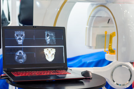 Computed tomography. Images of the human skull in laptops of the tamograph. Concept - equipment for...