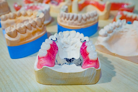 False jaw. Tooth plates. Sandwich denture. Orthopedic dental constructions. Denture model with...