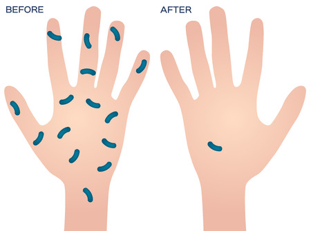 bacteria on hand vector , before afterのイラスト素材