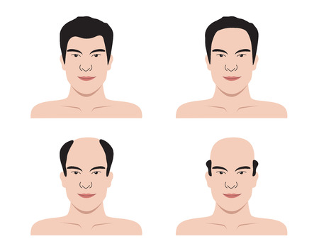 Stages of hair loss . bald man . no hairのイラスト素材