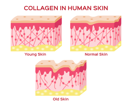 collagen in younger skin and aging skin , 3 type collagen skin versionのイラスト素材