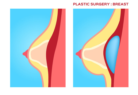 Plastic surgery of breast implantのイラスト素材
