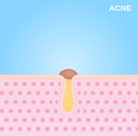 acne in skin vector . black head acneのイラスト素材