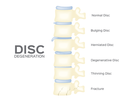 spine disc degeneration vector . back bone . anatomyのイラスト素材