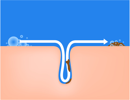 foam and soup bubble take out acne from the skin vectorのイラスト素材