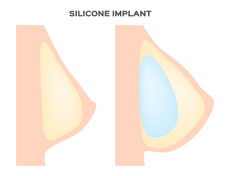 breast implant . cosmetic surgery vectorのイラスト素材