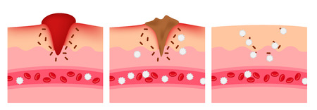 infographic of how the wound heal by platelet and white blood cell vectorのイラスト素材