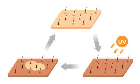 skin life cycle . uv makes skin dark and it peeling offのイラスト素材