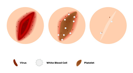 infographic of how the wound heal by platelet and white blood cell vectorのイラスト素材