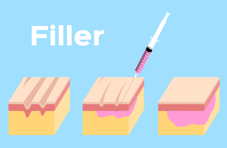 skin filler vector . It can cure the wrinkleのイラスト素材