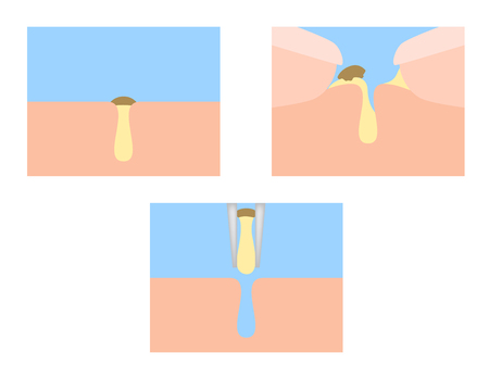 finger squeeze acne out vectorのイラスト素材