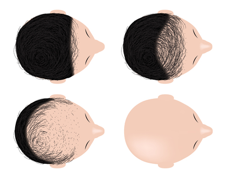 type of baldness , bald head vector . no hairのイラスト素材