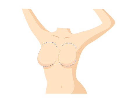 breast implant . cosmetic surgery vectorのイラスト素材