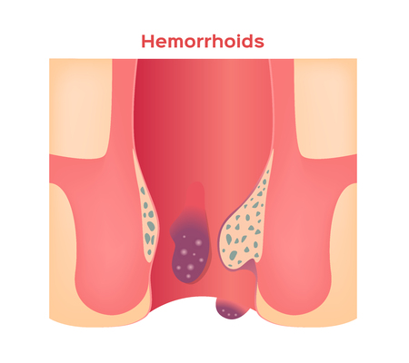 Hemorrhoids stage vector. ass and anusのイラスト素材