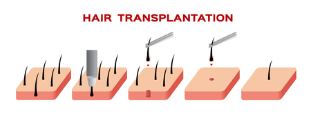 hair transplant vectorのイラスト素材