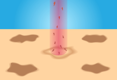 Laser cure freckle skin vectorのイラスト素材