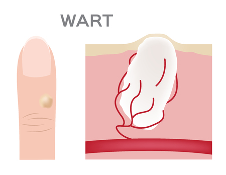 Wart on a person's hand close upのイラスト素材