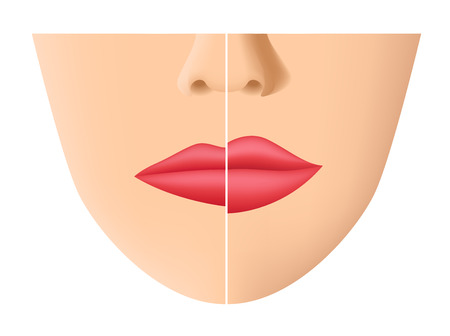 Lip and mouth skin filler vector.のイラスト素材