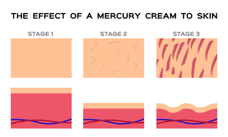Dangerous mercury cream damaged human skin vectorのイラスト素材