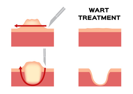 Wart treatment . Remove it from skin by surgery vector callusのイラスト素材