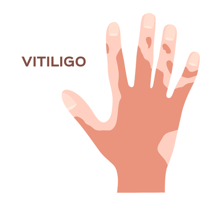 hand and effect of vitiligo vectorのイラスト素材