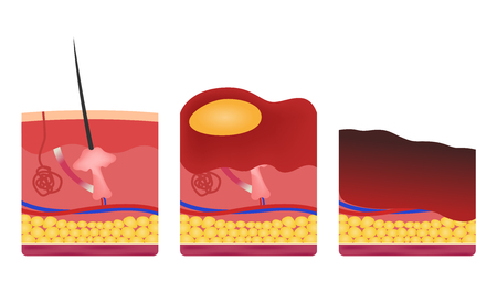 step of burn . Normal to serious burn skin . vector and iconのイラスト素材