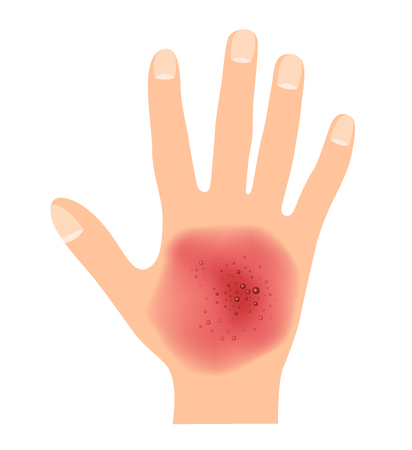 rash on hand skin vectorのイラスト素材